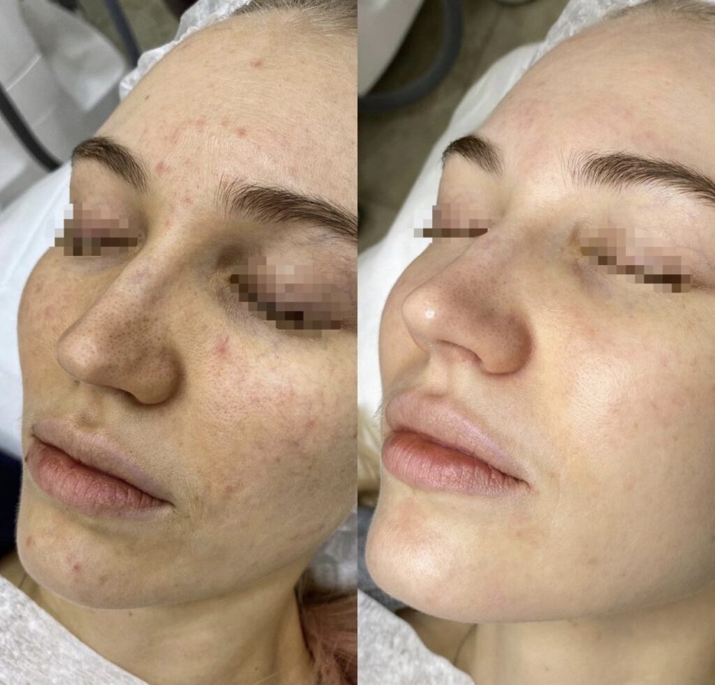 Laser Carbon Peel – Pure Aesthetics NY